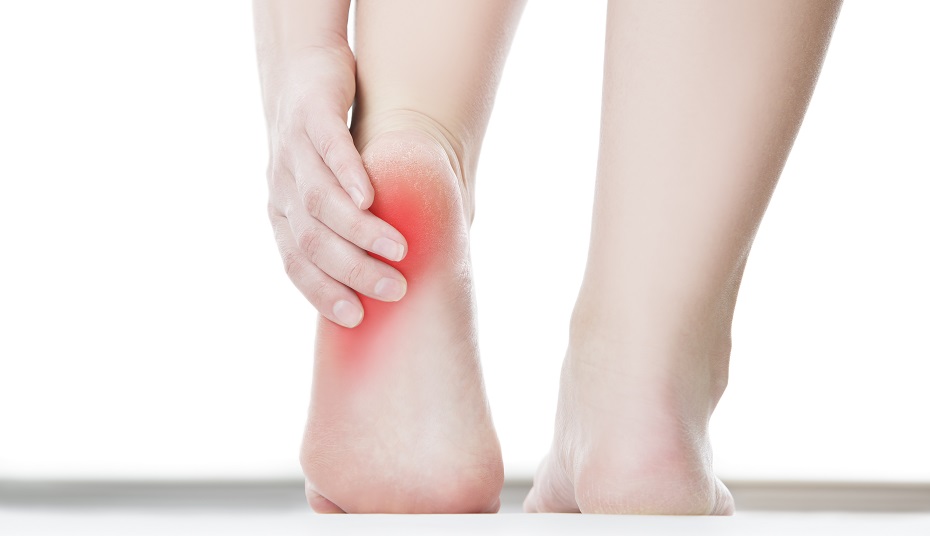 fascitis_plantar